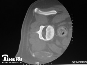 Tomografia komputerowa - poprzeczny przekrój w odcinku lędźwiowo-krzyżowym z widocznym ogniskiem osteolizy kości biodrowej