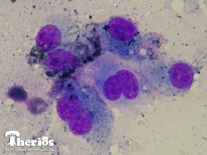Cytologiczny obraz czerniaka złośliwego: widoczne komórki nowotworowe częściowo wypełnione ciemnym barwnikiem