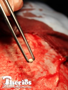  Implant cisplatynowy wszczepiany w PW THERIOS pacjentowi z czerniakiem złośliwym