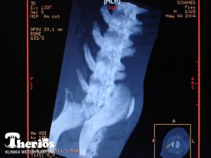 Tomografia komputerowa - przestrzenny obraz odcinka lędźwiowo-krzyżowego z widocznym ogniskiem osteolizy w obrębie lewego talerza biodrowego.