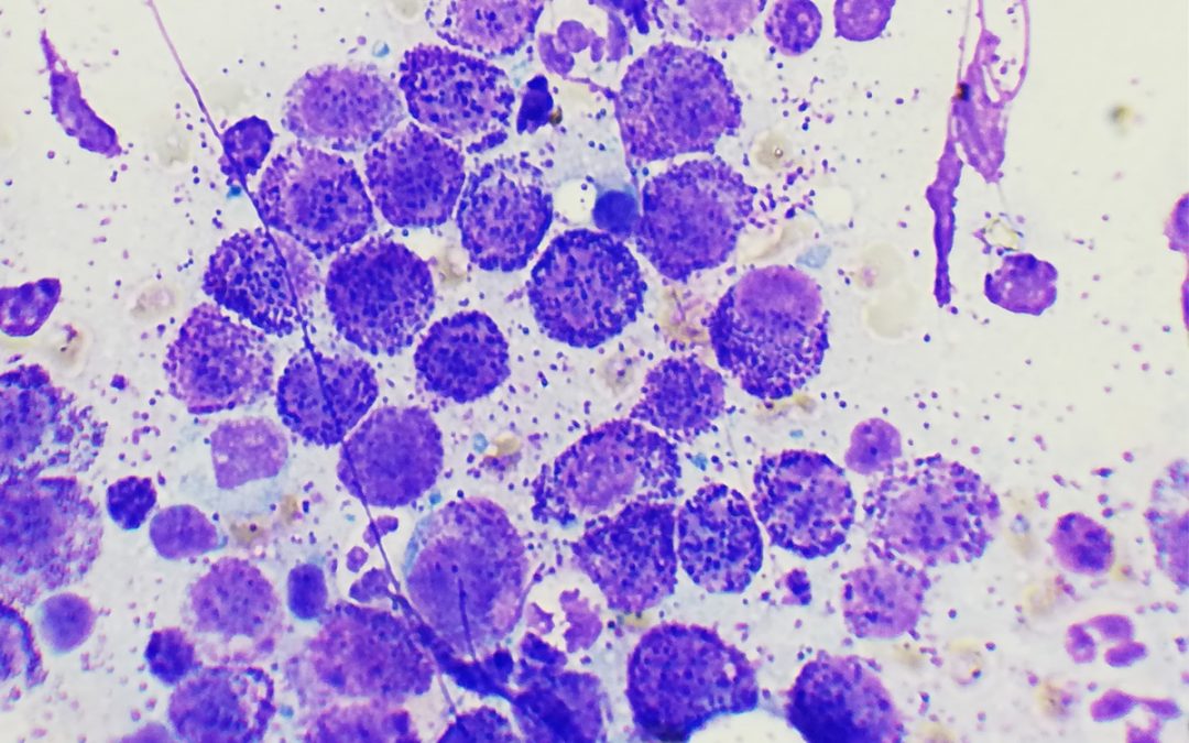 Guz komórek tucznych – zdradliwy nowotwór